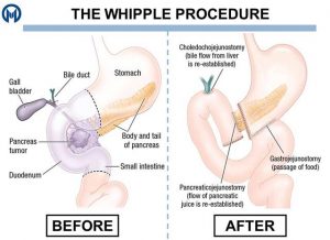 Appendisectomy_Laparoscopic_Jan_2019_001
